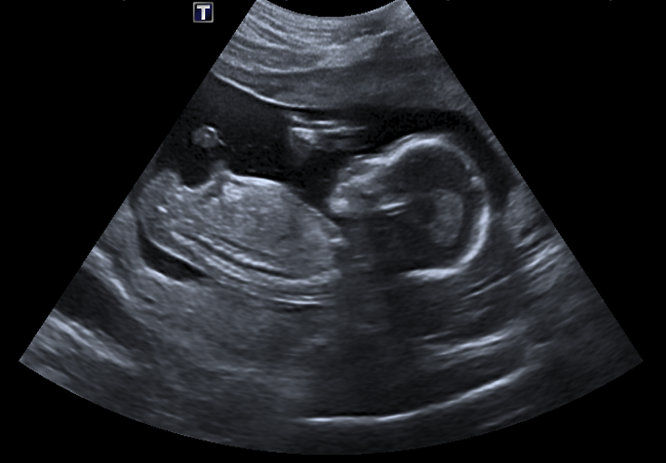 Bébé mesurant 2 semaines de retard au scan de datation