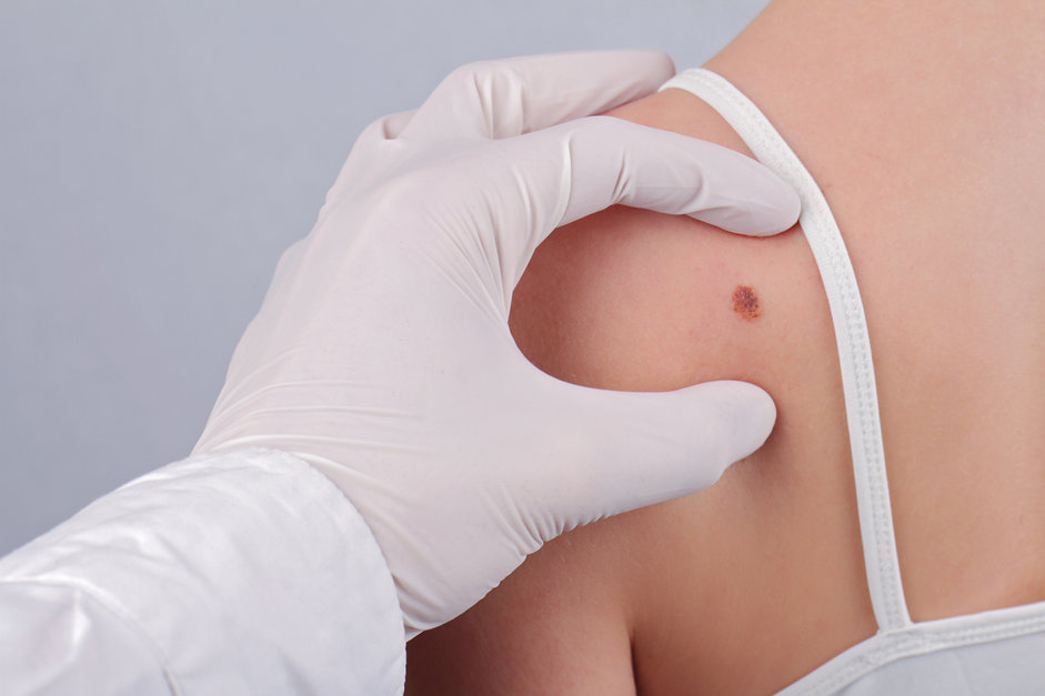 Le Point Sur Le Melanome Et Le Cancer De La Peau