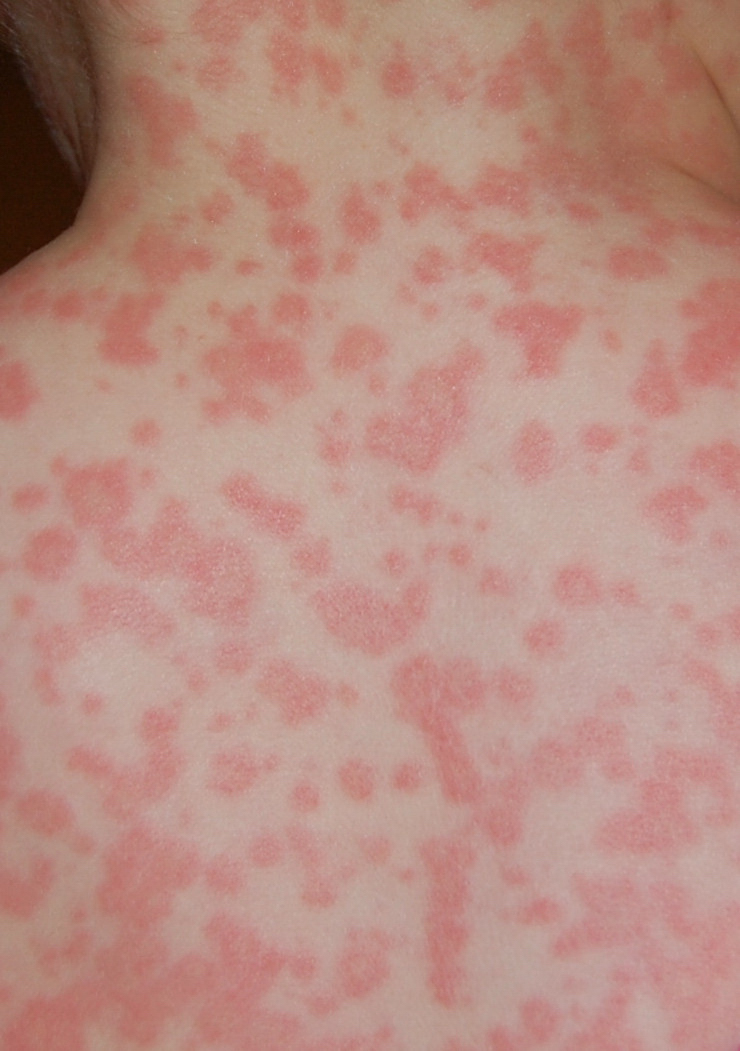 réaction cutanée grave