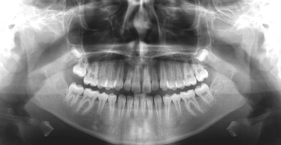 an oral-dental x-ray